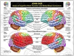 Areas of Cognitive Brain Function and Global Brain Contusions
