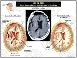 Basal Ganglia Infarct and Necrosis of the Brain
