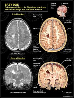 Subsequent Effects of a Right Interventricular Brain Hemorrhage and Ischemia