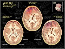 Normal vs. Frontal Brain Damage