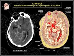 Subarachnoid Hemorrhage and Hydrocephalus of the Brain