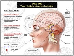 Visual-Vestibular Integration Dysfunction