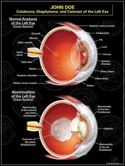 Coloboma, Staphyloma, and Cataract of the Left Eye