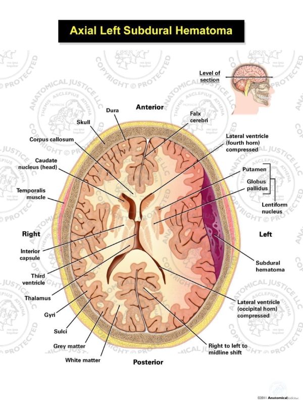 Subdural Hematoma Subdural Hematoma Medical Knowledge Neurology The The Best Porn Website