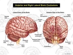 Anterior and Right Lateral Brain Contusions