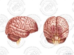 Anterior and Right Lateral Brain Contusions – No Text
