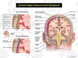 Coronal Right Subarachnoid Hematoma with Enlarged Details