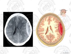 CT of the Brain with Left Epidural Hematoma – No Text