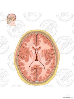 Edema of the Brain – Cross Section – No Text