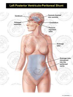 Female Left Posterior Ventriculo – Peritoneal Shunt