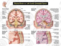 Normal Brain vs. Left Cystic Cerebellar Tumor