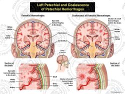 Left Petechial vs. Coalescence of Petechial Hemorrhages
