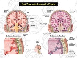Post – Traumatic Brain with Edema