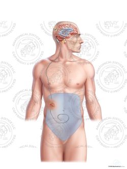 Male Right Posterior Ventriculo – Peritoneal Shunt – No Text