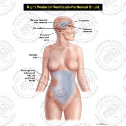 Female Right Posterior Ventriculo – Peritoneal Shunt