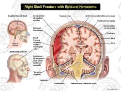 Right Skull Fracture with Epidural Hematoma