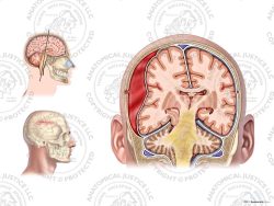 Right Skull Fracture with Epidural Hematoma – No Text
