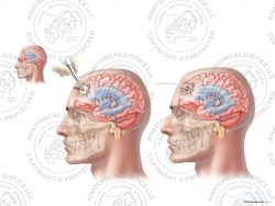 Male Left Anterior Placement of Ventriculostomy Catheter – No Text