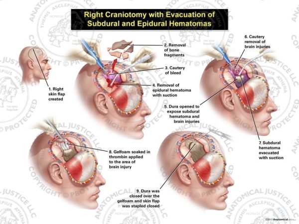 Male Right Craniotomy With Evacuation Of Subdural And Epidural Hematomas