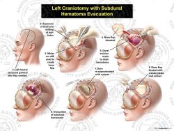 Female Left Craniotomy with Subdural Hematoma Evacuation