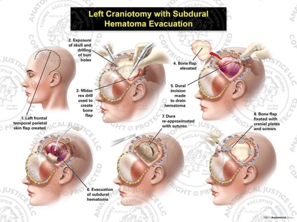 Female Left Craniotomy With Subdural Hematoma Evacuation