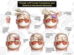 Male Left Frontal Craniotomy and Subdural Hematoma Removal