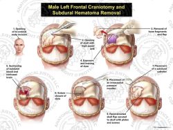 Female Right Frontal Craniotomy and Subdural Hematoma Removal