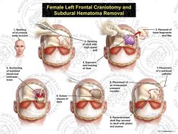 Female Left Frontal Craniotomy and Subdural Hematoma Removal
