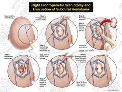 Right Frontoparietal Craniotomy and Evacuation of Subdural Hematoma