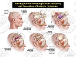 Male Right Frontotemporoparietal Craniotomy and Evacuation of Subdural Hematoma