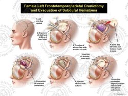 Female Left Frontotemporoparietal Craniotomy and Evacuation of Subdural Hematoma
