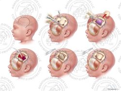 Infant Left Craniotomy and Evacuation of Subdural Hematoma – No Text