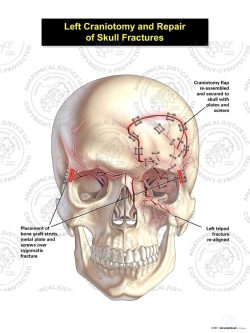 Left Craniotomy and Repair of Skull Fractures