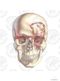 Left Craniotomy and Repair of Skull Fractures – No Text