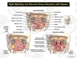 Right Maxillary and Ethmoid Sinus Infections with Repairs