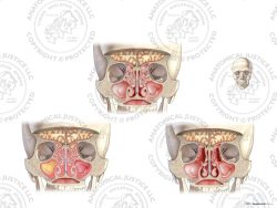 Right Maxillary and Ethmoid Sinus Infections with Repairs – No Text