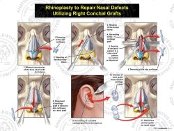 Rhinoplasty to Repair Nasal Defects Utilizing Right Conchal Grafts