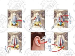 Rhinoplasty to Repair Nasal Defects Utilizing Right Conchal Grafts – No Text
