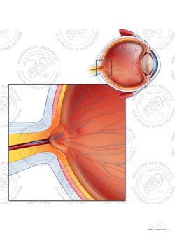 Cupped Optic Disc of the Left Eye – No Text
