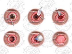 Enucleation of the Right Eye with Orbital Implant – No Text