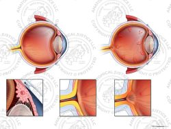 Normal vs. Open Angle Glaucoma of the Left Eye – No Text