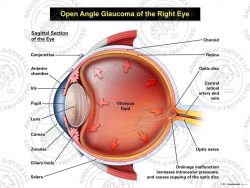 Open Angle Glaucoma of the Right Eye