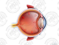 Open Angle Glaucoma of the Left Eye – No Text