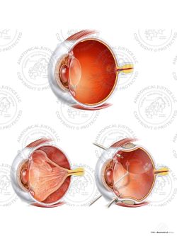 Retinal Detachment and Repair of the Right Eye – No Text