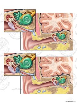 Normal Right Ear Anatomy vs. Perilymphatic Fistulas – No Text