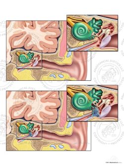 Normal Left Ear Anatomy vs. Perilymphatic Fistulas – No Text