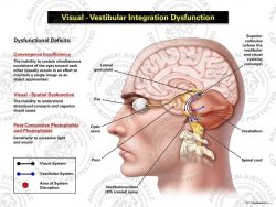 Male Left Visual – Vestibular Integration Dysfunction