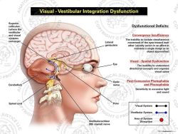 Female Right Visual – Vestibular Integration Dysfunction