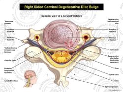 Right Cervical Degenerative Disc Bulge