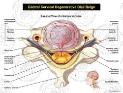 Central Cervical Degenerative Disc Bulge
